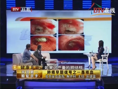 区主任提示:肺癌早期信号之一 咳血