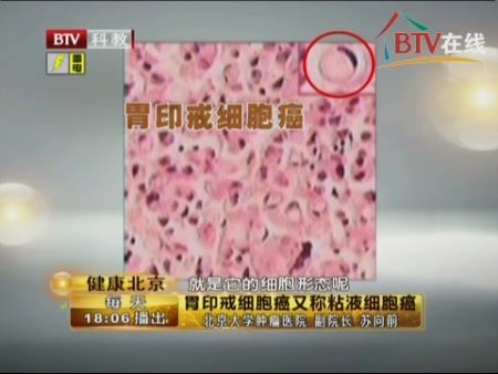 苏副院长介绍胃印戒案胞癌