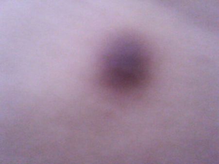 图为小玉自己拍摄胳膊皮下纤维瘤,大腿内侧较为严重已手术