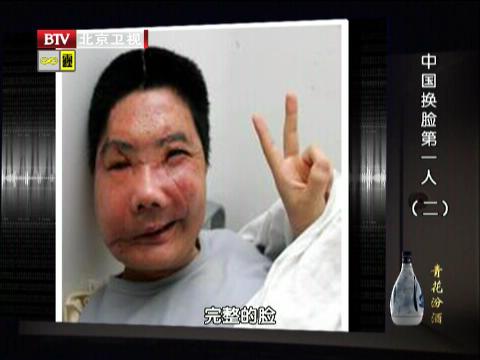 手术后的李国兴