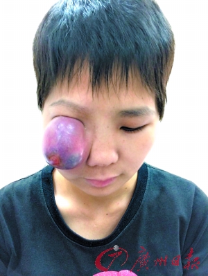 恶性肿瘤苹果大 花季少女右眼被挤瞎