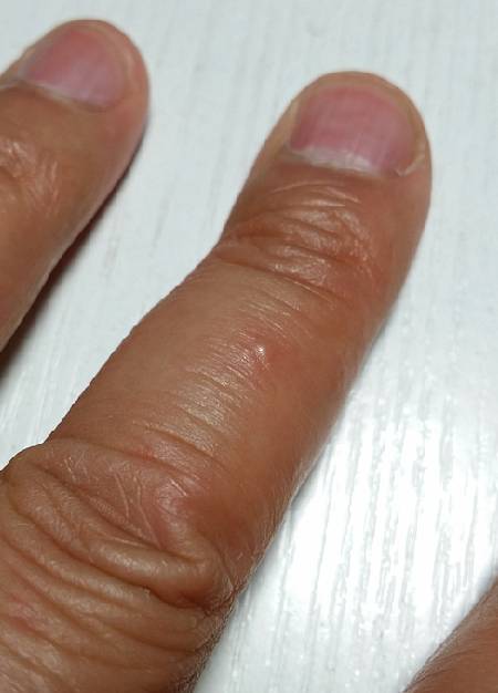 这个症状,西医称为湿疹,或者是水疱型手癣,中医称为鹅掌风.