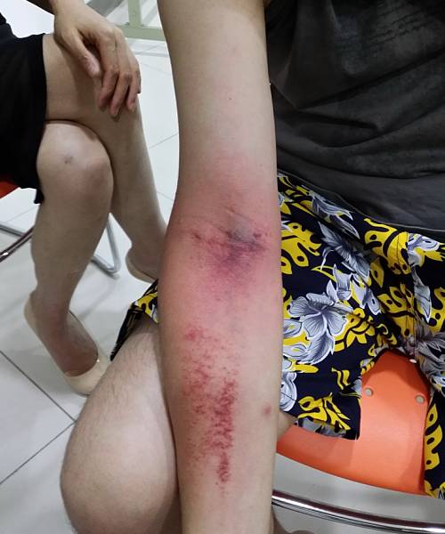 我给其手臂关节处拍痧,心包经出痧明显