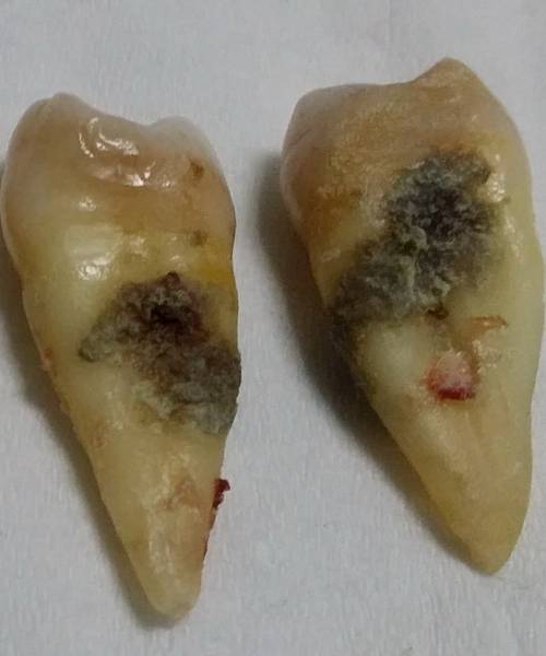 1,牙齿看起来好好的,为什么要选择拔牙?