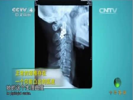 中华医药小针刀治疗颈椎病