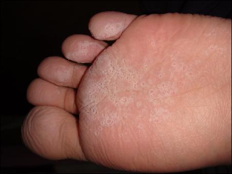 西医通常将脚气认定为是一种由真菌引起的皮肤感染;而中医通常把脚气