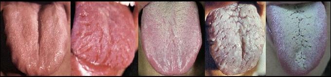 揭露裂纹舌出现原因及治疗方法