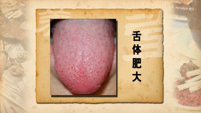 图示1-舌体肥大