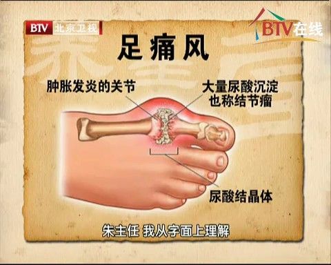 足痛风