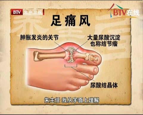 btv养生堂朱跃兰复杂病症早梳理 - 别有病 byb.