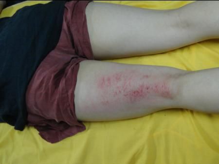 浙江学员大腿膀胱经出痧情况