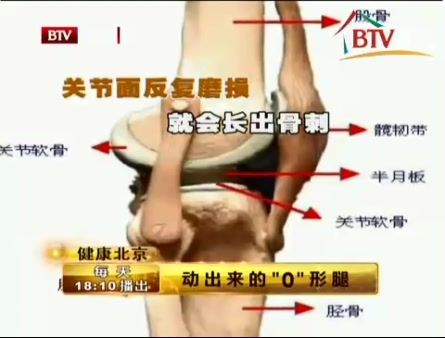 健康北京动出来的O型腿-骨性关节炎