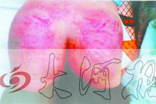 8岁男童被疑偷手表2天遭老师4次毒打