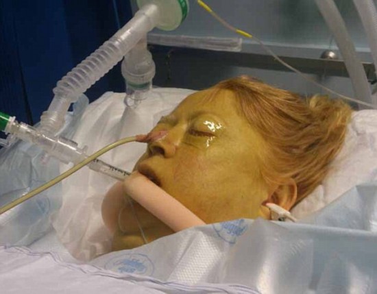 自19岁时便开始喝酒,25年来平均每周摄入350单位的酒精,最终患上肝