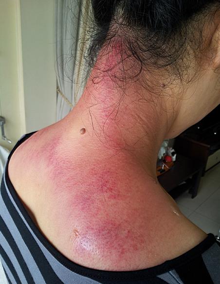 31别有病网第21期刮痧培训纪实