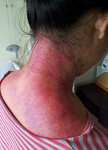 31别有病网第21期刮痧培训纪实