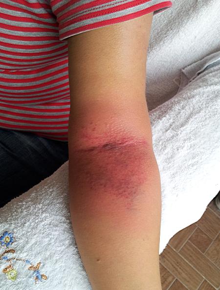 拍打其左臂肘关节,心包经出痧明显