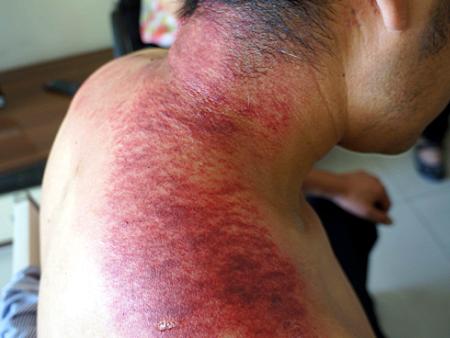 31别有病网第21期刮痧培训纪实