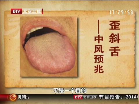 歪邪舌是中风先兆
