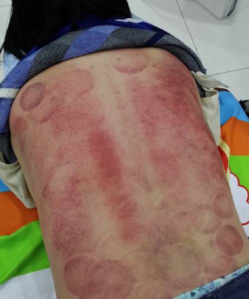 杭州一家三口北京刮痧求学记