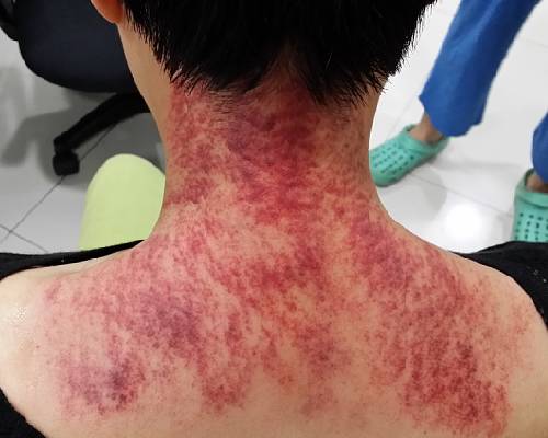 她说以前很少刮过脖子,堵的厉害,出痧明显.刮过后,她说感觉很爽