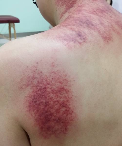 14别有病网第25期刮痧培训纪实