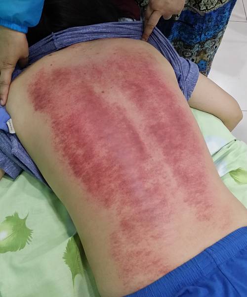 14别有病网第25期刮痧培训纪实