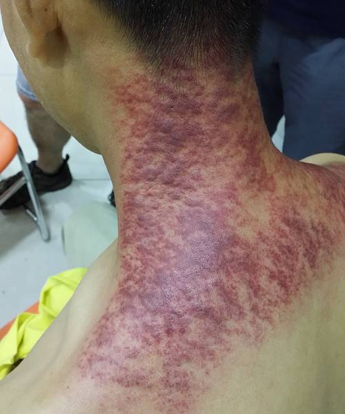 12别有病网第26期刮痧培训纪实