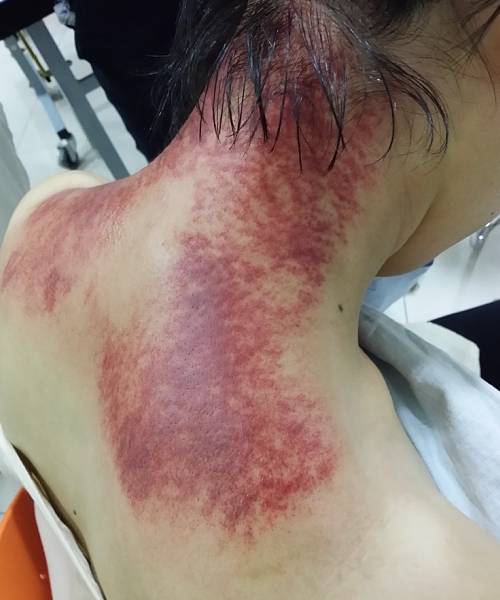 9别有病网第27期刮痧培训纪实