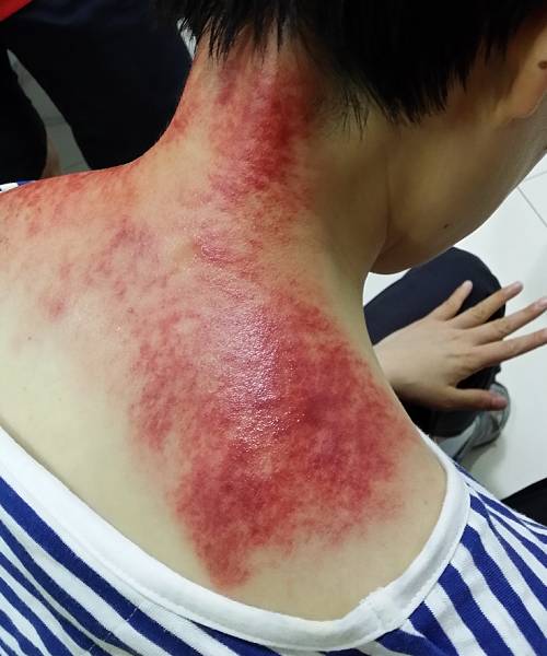 8.9别有病网第27期刮痧培训纪实