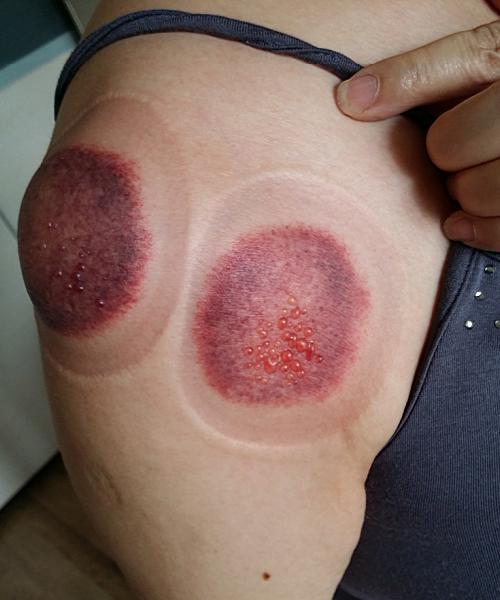 拔罐治肩周炎水去血来