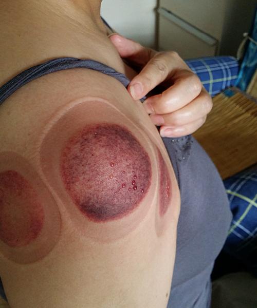 拔罐治肩周炎水去血来