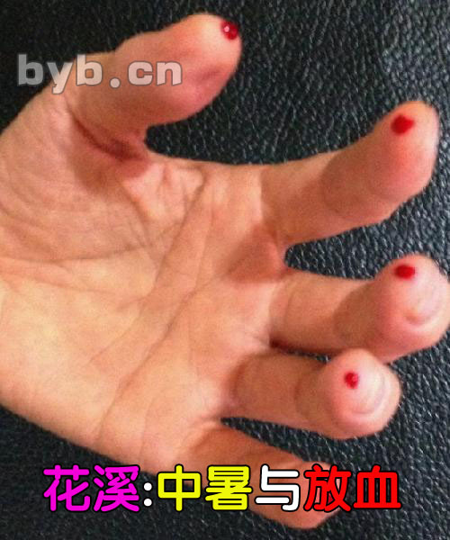 花溪:中暑与放血