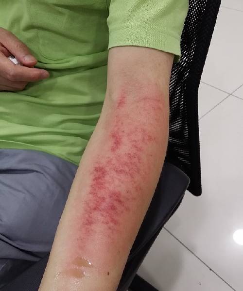 14一波三折的刮痧培训