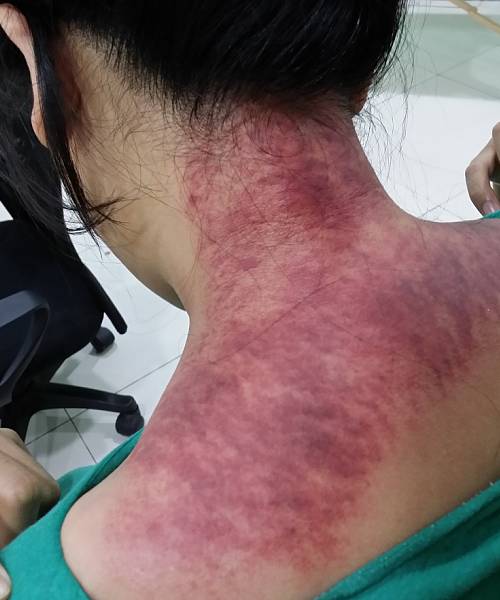 14一波三折的刮痧培训