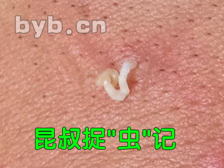 从皮肤里挤出的脂肪颗粒