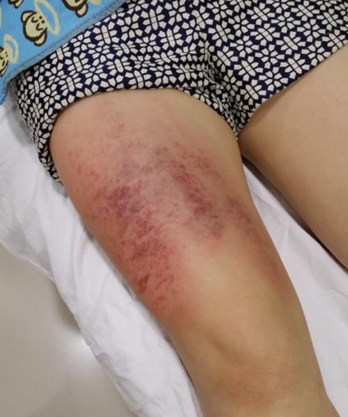 21别有病网第28期刮痧培训纪实