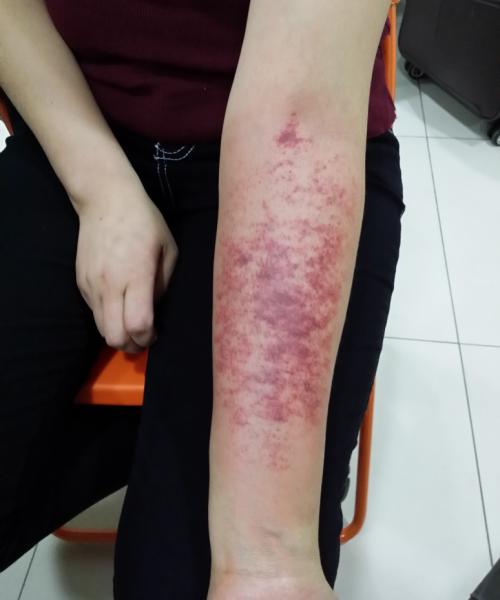 21别有病网第28期刮痧培训纪实