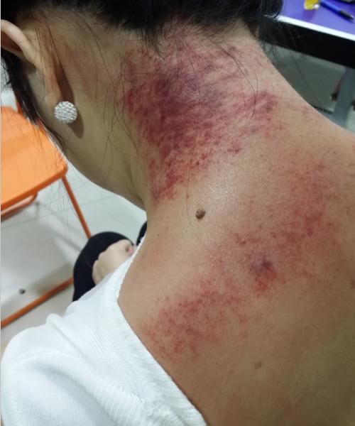 21别有病网第28期刮痧培训纪实