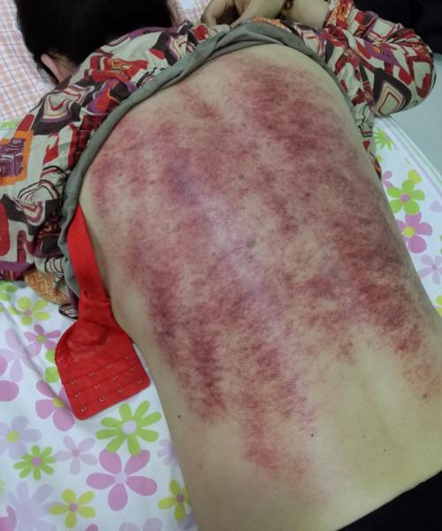 不过,从其后背的情况看,阳气闭住的很厉害,刮痧时也感觉比较痛,身体内