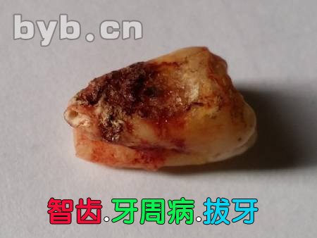 byb.cn 智齿.牙周病.拔牙