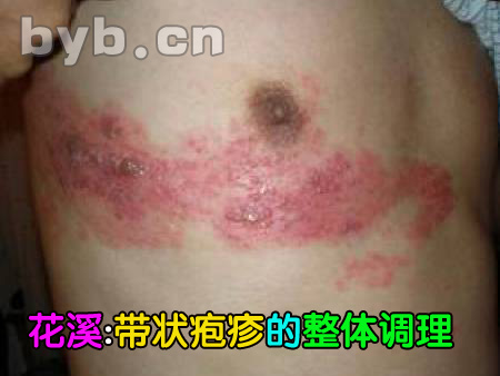 byb.cn 带状疱疹