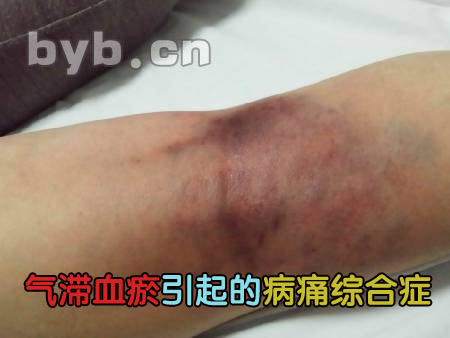 byb.cn 气滞血瘀