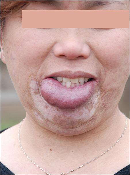 求治:女子面部患巨大血管瘤