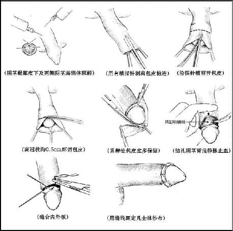 包茎套环手术过程图片