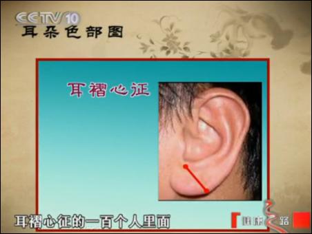 耳褶心征 科学依据图片