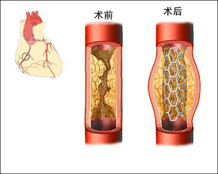 心脏支架手术要多久图片