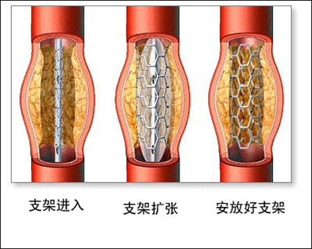 血管支架 示意图图片