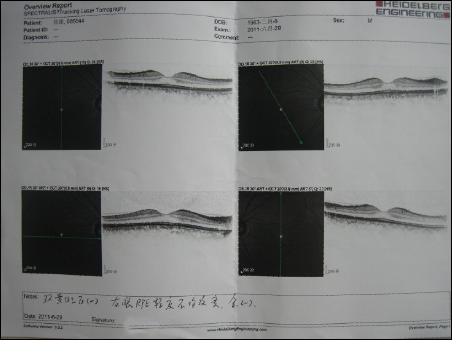 视网膜脱离oct报告图图片