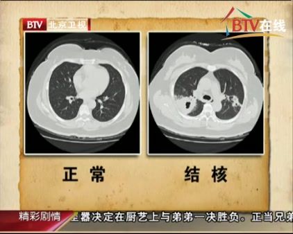 肺结核照片图解图片